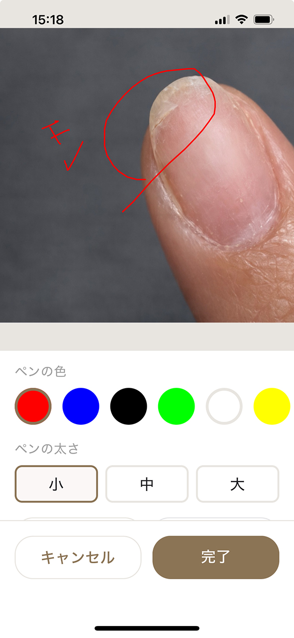 ネイルカルテ 施術写真への手書きメモ